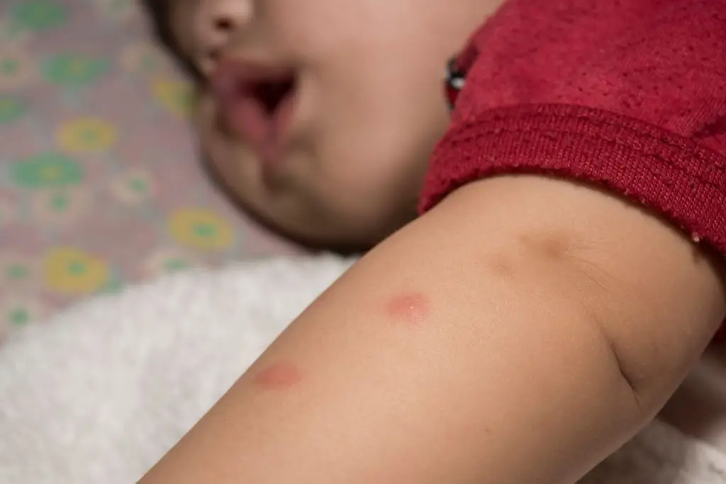 Mosquito bites on a baby's arm, showing how they look, above information on how to keep mosquitos away from baby. 